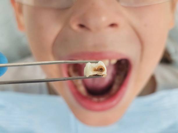 Best Emergency Tooth Extraction in Centerville, SC